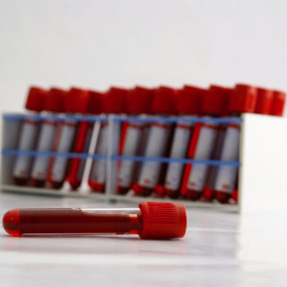 Ask Dr. Santa Maria: Albumin, Bilirubin and AST Blood Results