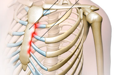 Unexplained Chest Pain? It Could be Costochondritis—What Does it Feel Like—And How Do You Treat It?